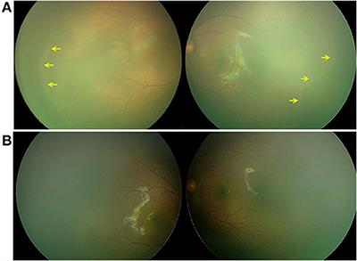 ROP-like retinopathy in full/near-term newborns: A etiology, risk factors, clinical and genetic characteristics, prognosis and management